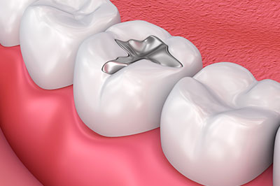 The image shows a close-up view of a dental implant being inserted into a prepared tooth socket within an oral cavity, with visible gum tissue and teeth on either side.