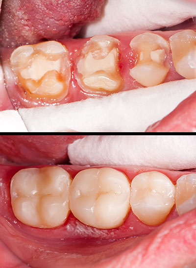 The image shows two photographs side by side  on the left, an open mouth with several teeth missing and a gumline filled with plaque  on the right, the same mouth after dental treatment, with teeth restored and clean gums.