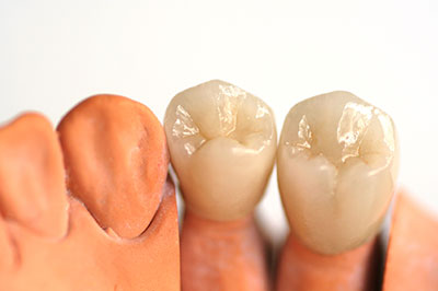 An image showing two artificial teeth with a dental implant structure, set against a white background.