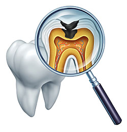 The image shows a magnified view of a dental X-ray with an overlay of a toothbrush, and there s a detailed illustration of a tooth with its root system highlighted by red and blue areas, along with a visible cavity.