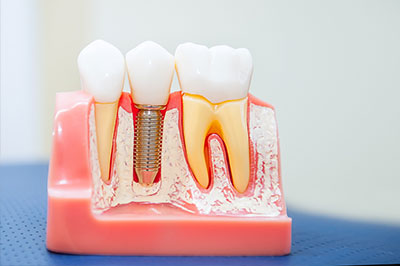 The image shows a clear plastic model with teeth and gums, featuring several toothpicks inserted into different parts of the mouthpiece, simulating dental implants.