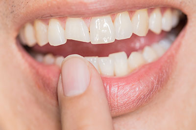 The image shows a close-up view of a person s smiling mouth with white teeth, holding their finger near their lips, suggesting they may be brushing their teeth or cleaning their teeth.