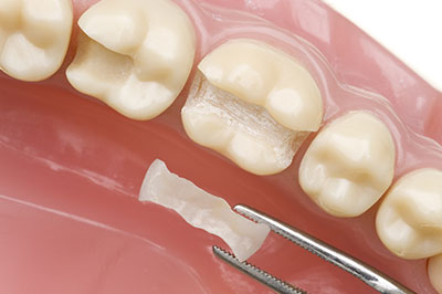 The image shows a close-up view of a dental implant being fitted into a tooth socket with a small amount of bone grafting material visible on the implant.