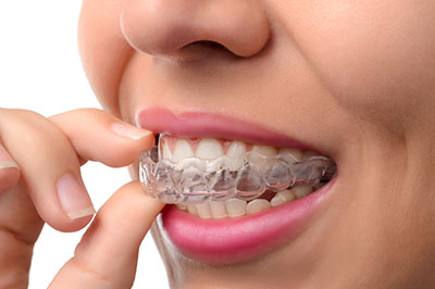 The image shows a person with a full set of clear braces, holding their finger near their teeth while smiling.