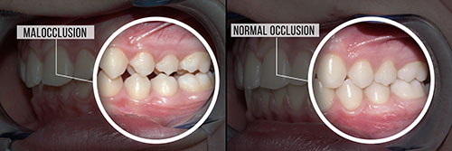 The image shows two photographs of a person s mouth with severe dental decay, with one photo labeled  Malocclusion  and the other labeled  Normal occlusion,  highlighting the difference between an improperly aligned bite and a properly aligned one in terms of oral health.