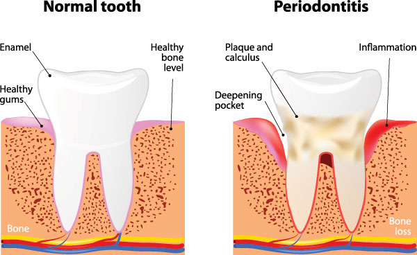 The image presents a detailed medical illustration of a tooth with the caption  Normal tooth  at the top left, followed by two stages of dental decay labeled  Periodontitis  on the right side, showing progression from healthy bone and tissue to severe decay and inflammation.