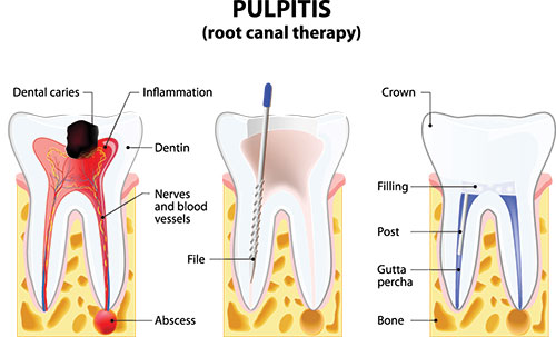 The image depicts a diagrammatic illustration of a process involving dental care, specifically pulpitis, with annotations detailing the steps from initial symptoms to treatment options.