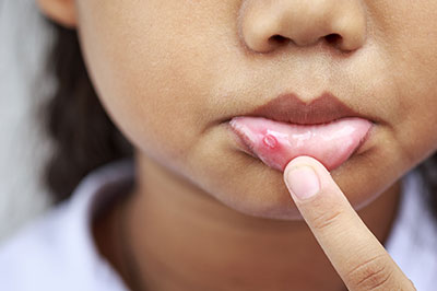 The image shows a close-up of a young person s face with a focus on their lips, which appear to be affected by a skin condition such as chapped or cracked lips.