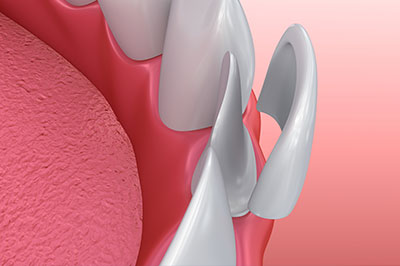 The image shows a close-up view of a dental implant with a screw partially inserted into a prepared tooth socket, set against a medical background with a pinkish hue.