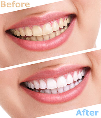 The image shows a before-and-after comparison of teeth whitening, with a smiling woman displaying two sets of teeth  one set showing discoloration and the other appearing brightened after treatment.