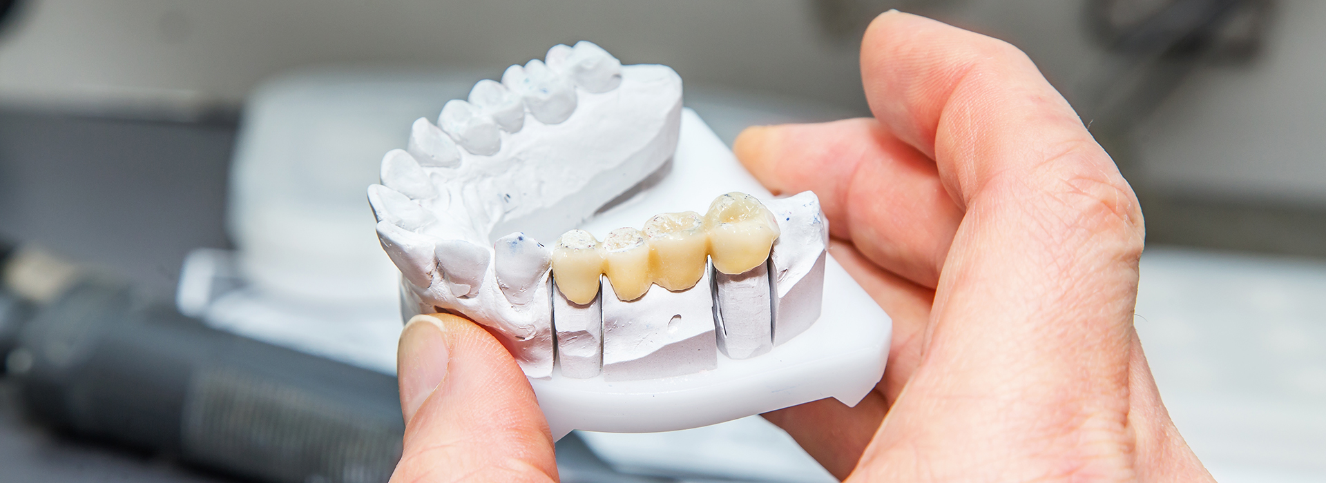 The image shows a person s hand holding a 3D printed dental model with multiple teeth missing.