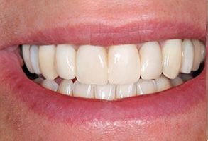 The image shows a close-up of a person s smiling mouth with teeth, revealing a bright smile.