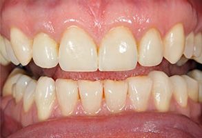 The image shows a close-up view of a person s teeth with yellowish staining, suggesting poor oral hygiene or dental issues.