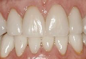 The image shows a close-up view of a person s teeth with a focus on an upper denture.