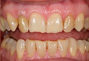 The image displays a close-up view of a person s teeth with a focus on dental work, possibly after a cleaning or treatment, showcasing a bright smile with yellowish stains.