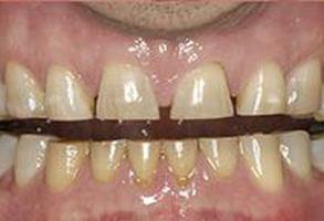 The image shows a close-up of an individual s mouth with teeth that appear yellowed and stained, likely due to tobacco use, and there are signs of dental decay and wear.